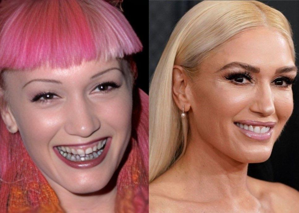 Look at Celebrities' Real Teeth If You're Insecure About Yours!