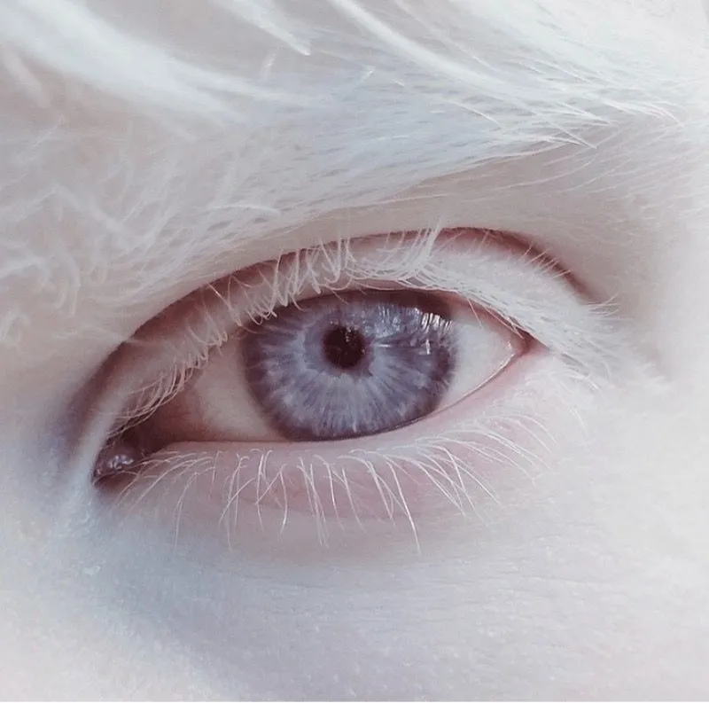 28. Albinism Affecting the Eyes.jpg?format=webp