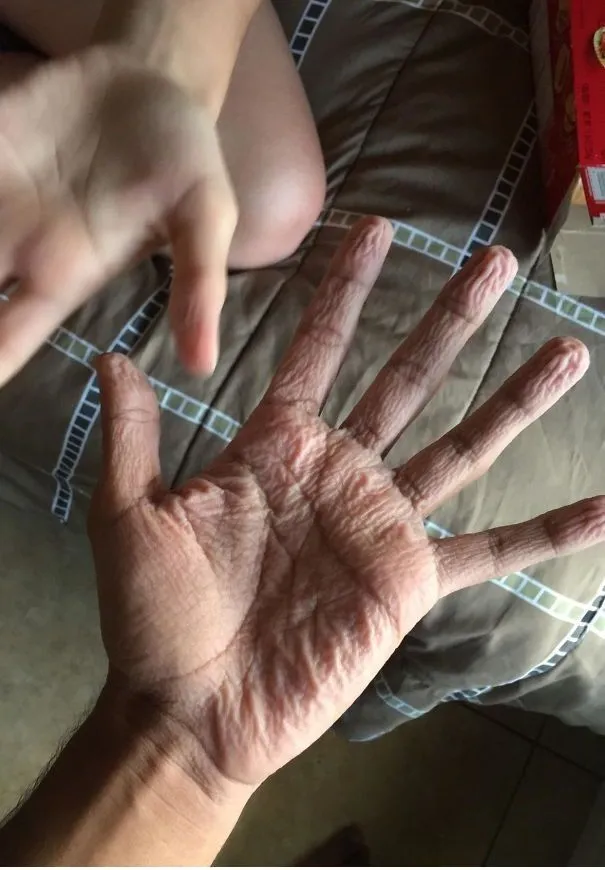 31. Abnormal Wrinkly Hands.jpg?format=webp