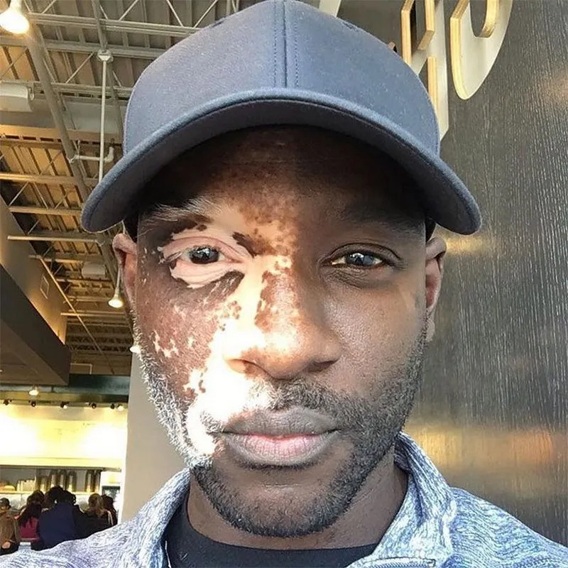 50. Vitiligo Impacting One Side of a Man's Face.jpg?format=webp